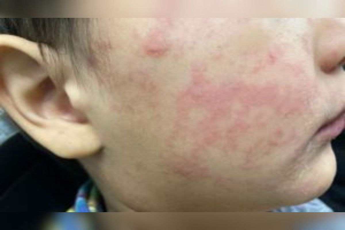 Measles rash